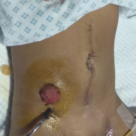Stoma care Pakistan