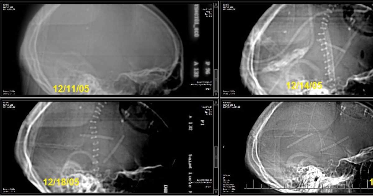Story about Colloid cyst