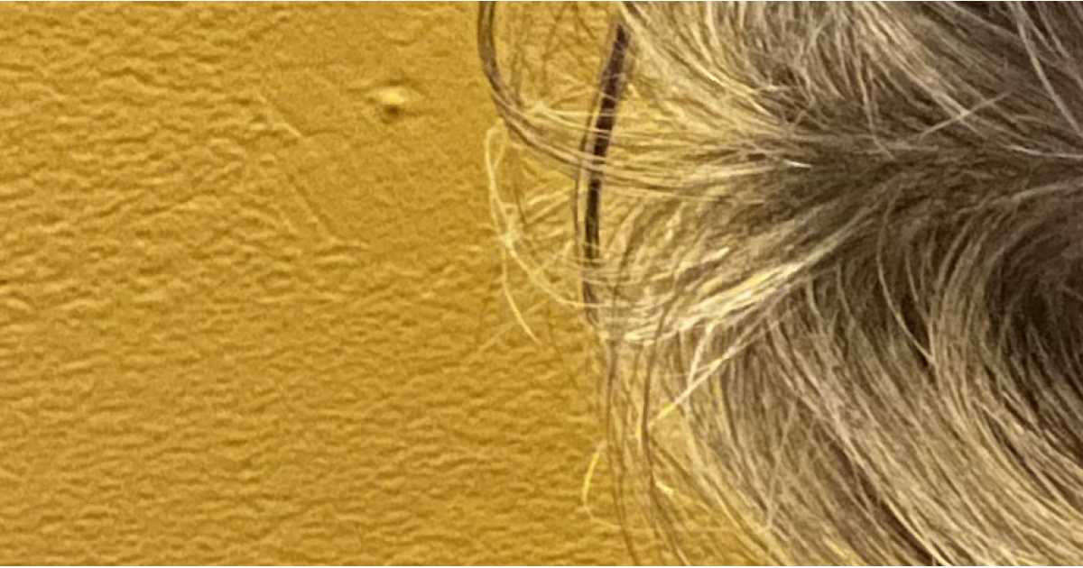 Story about Fibromuscular dysplasia